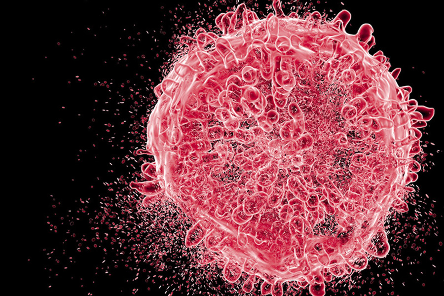 Example of B-cell acute lymphoblastic leukemia